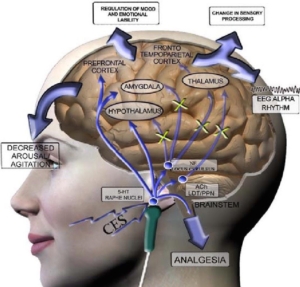 Cranial Elektrische Stimulation der sanfte Weg der Suchtbefreiung